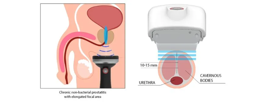 Shockwave-รักษาภาวะหย่อนสมรรถภาพทางเพศชาย Shockwave-รักษาภาวะหย่อนสมรรถภาพทางเพศชาย