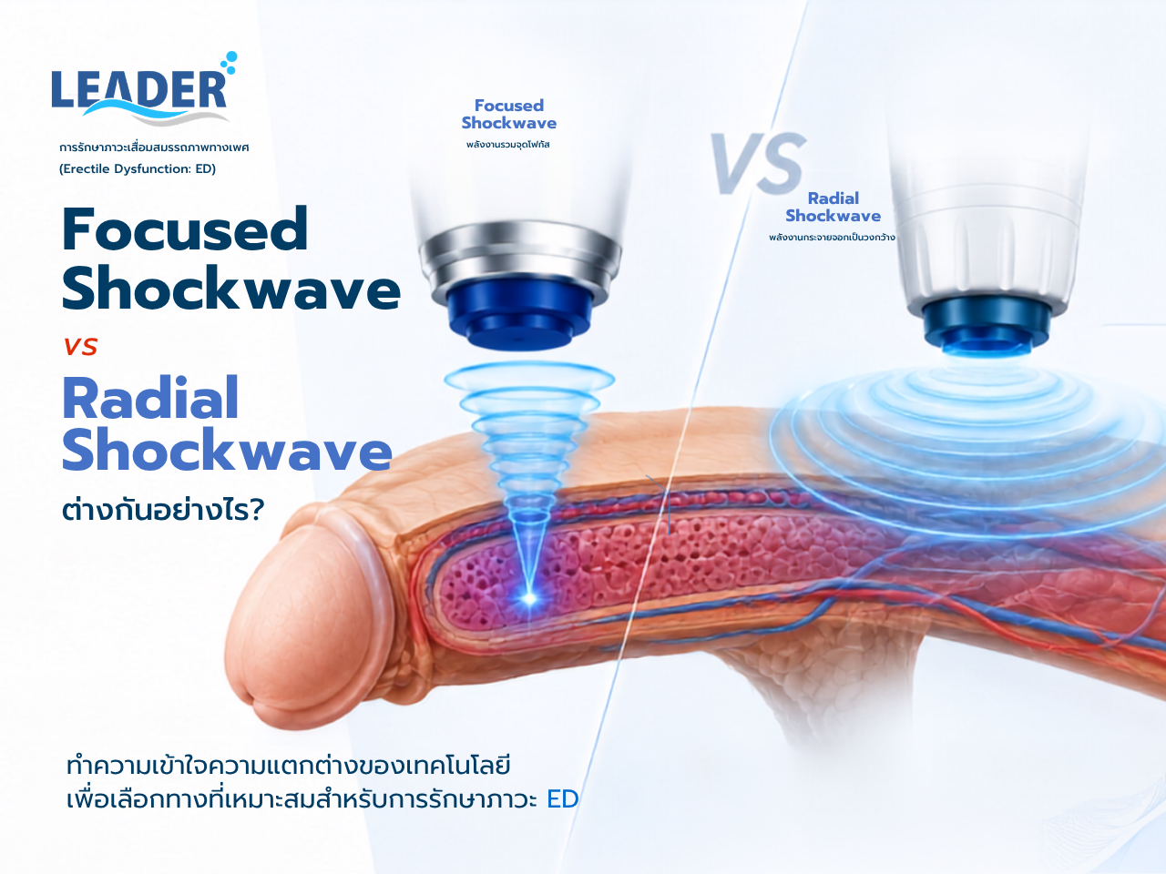 Focused Shockwave vs Radial Shockwave ต่างกันอย่างไร? เลือกเครื่อง ED Shockwave แบบไหนสำหรับรักษาภาวะ ED